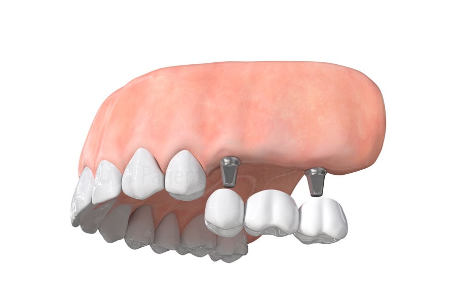 Dental Implant Bridge in Chicago, IL