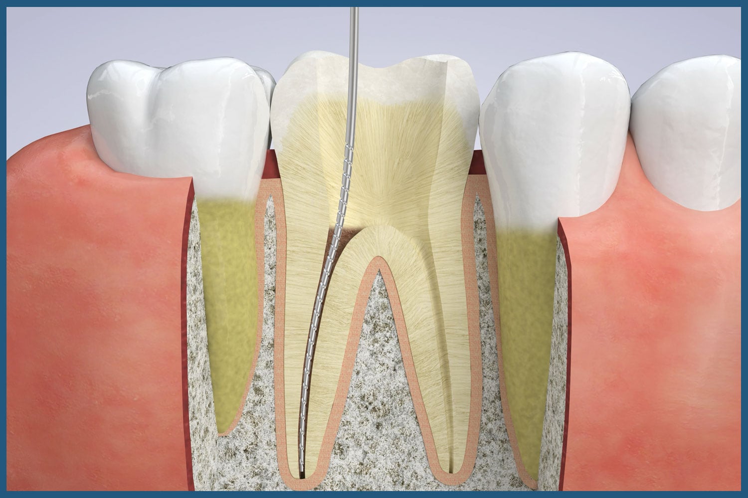 Stages of Root Canal Therapy in Chicago, IL